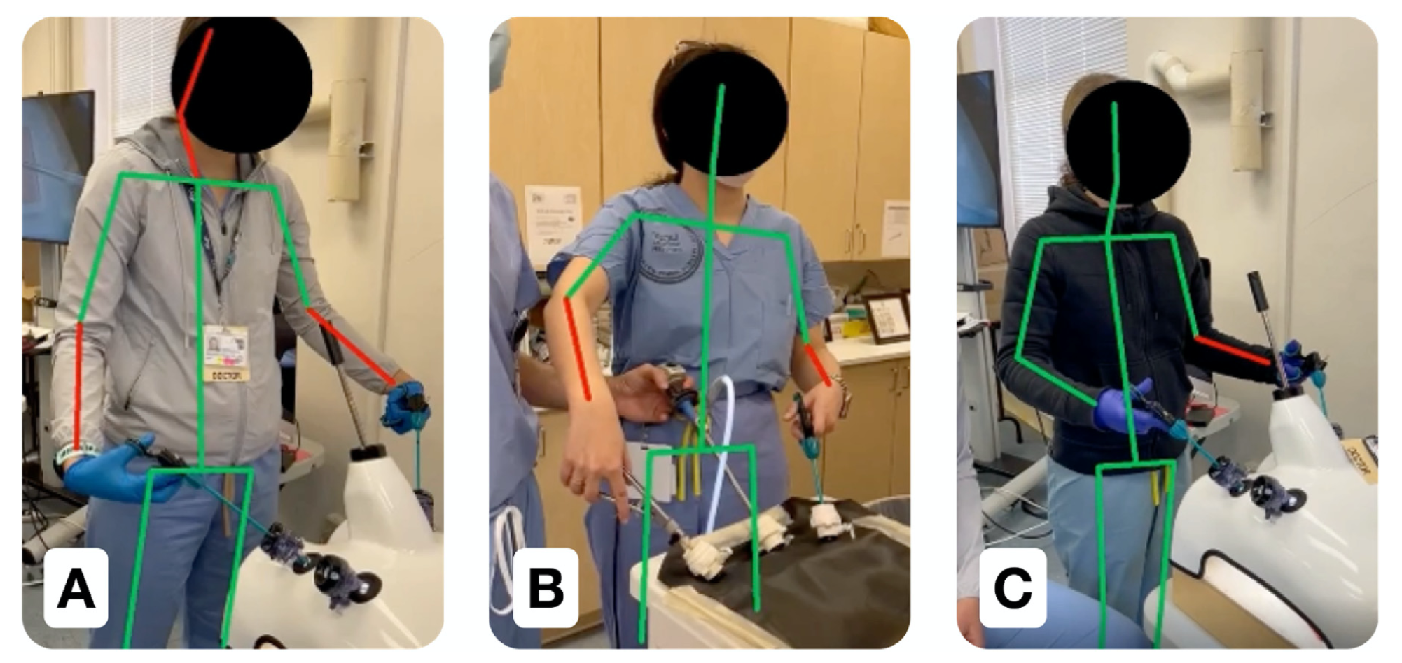 Image is 3 images of Surgeons in the operating theatre with AI pose estimation landmarks overlain over their joints. Lines in red denote unsafe angles their joints are in. 